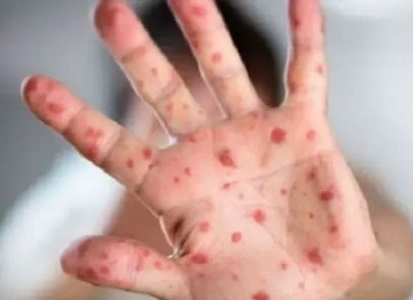 Стало известно, сколько продлится карантин на Закарпатье из-за дифтерии