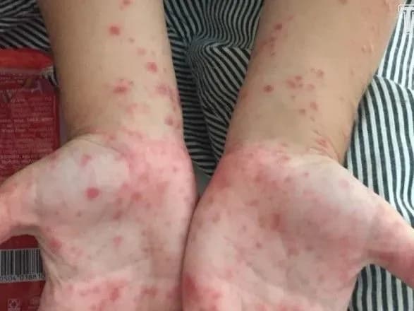 Вісім класів одеських шкіл закриті на карантин через небезпечне захворювання