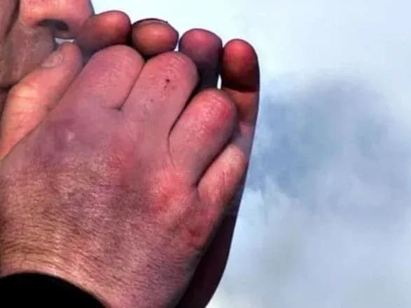 У Києві за минулу добу від переохолодження постраждала одна людина