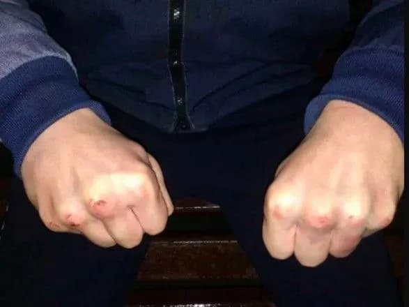 На Черкащині двом неповнолітнім повідомили про підозру за побиття підлітків