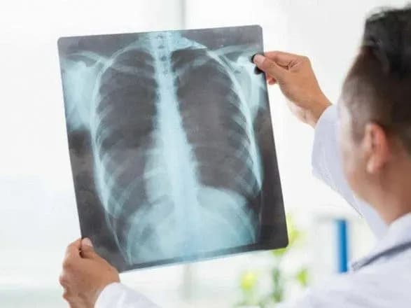 В Україні різко зростає кількість людей із пневмонією - Степанов