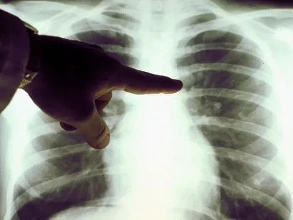 В Україні від грипу та пневмонії за чотири місяці померло понад 2 тис. осіб