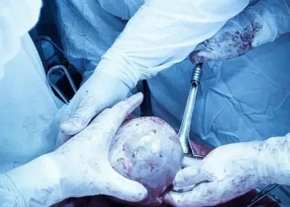 У Львові жінці видалили півторакілограмову кисту