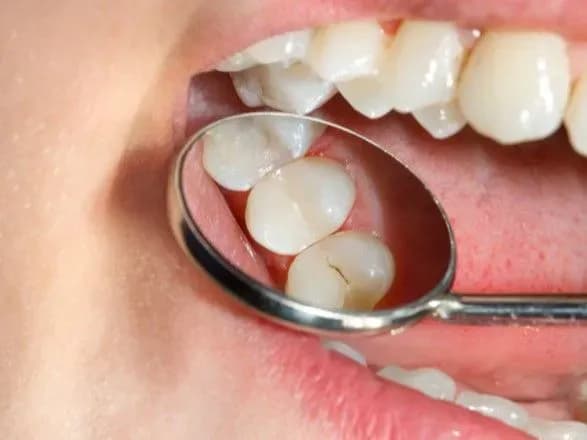 4 июня отмечается Международный день борьбы с кариесом