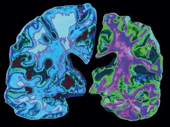 У США схвалили нові ліки від хвороби Альцгеймера