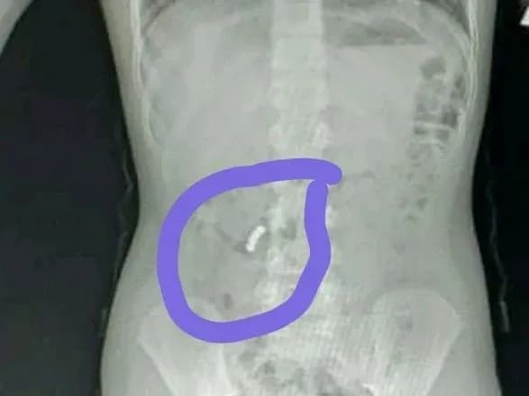 У Чорноморську дитина проковтнула 4 магніти, які почали пробивати внутрішні органи