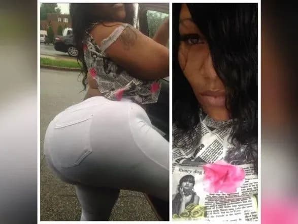 Кашляла кровью: в США женщина умерла после инъекции по увеличению ягодиц