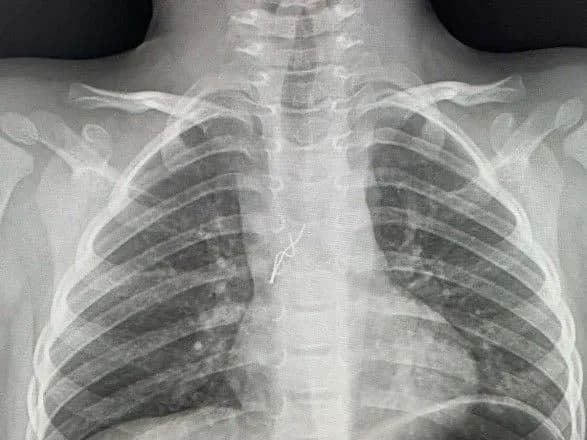 Почав кашляти та задихатися: у Львові з бронхів чотирирічного хлопчика дістали лампочку від гірлянди