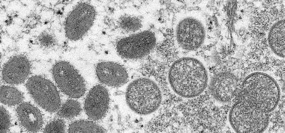 ВООЗ попереджає, що випадки віспи мавп можуть бути "вершиною айсбергу"