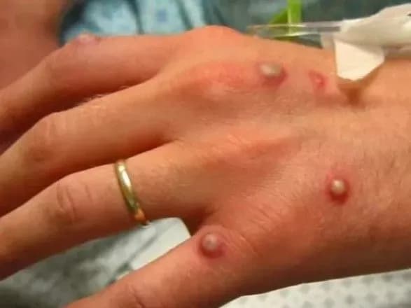 У Грузії зафіксовано перший випадок віспи мавп