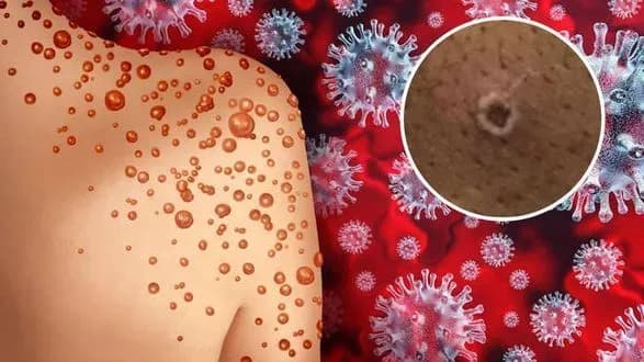 Близько 1700 людей у Франції заразилися мавпячою віспою – міністр