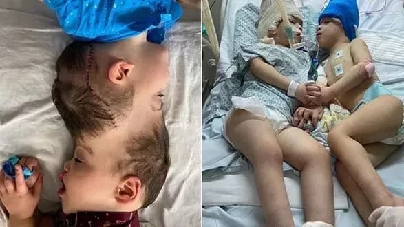 Сіамських близнюків в Бразилії розділили за допомогою віртуальної реальності