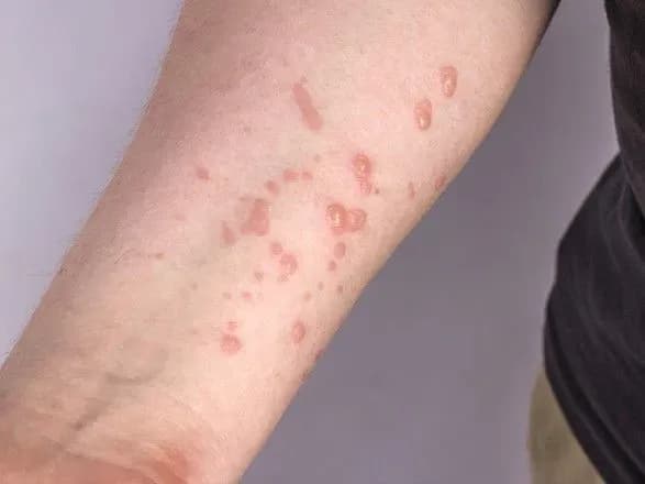 В Україні зафіксовано новий випадок віспи мавп: усі пацієнти мають легкий перебіг захворювання