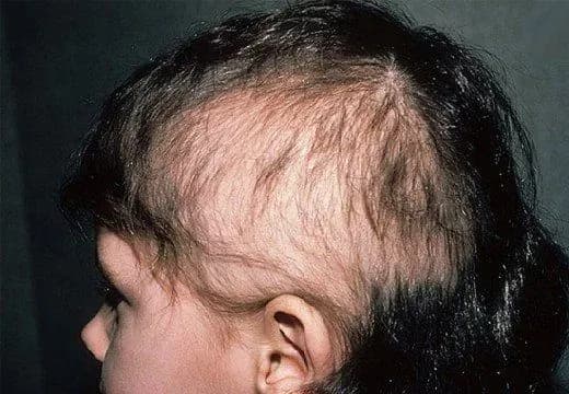 День алопеции: точная причина массового облысения детей в одном из украинских городов в 1988 году до сих пор не названа