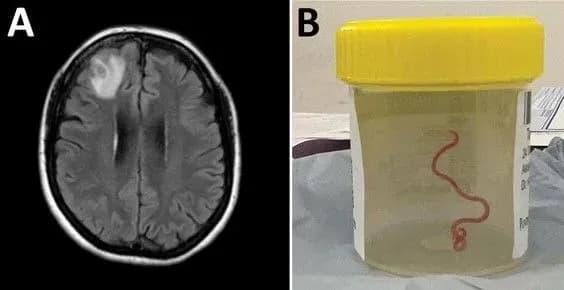 Австралійка рік жила із живим черв’яком аскариди у мозку