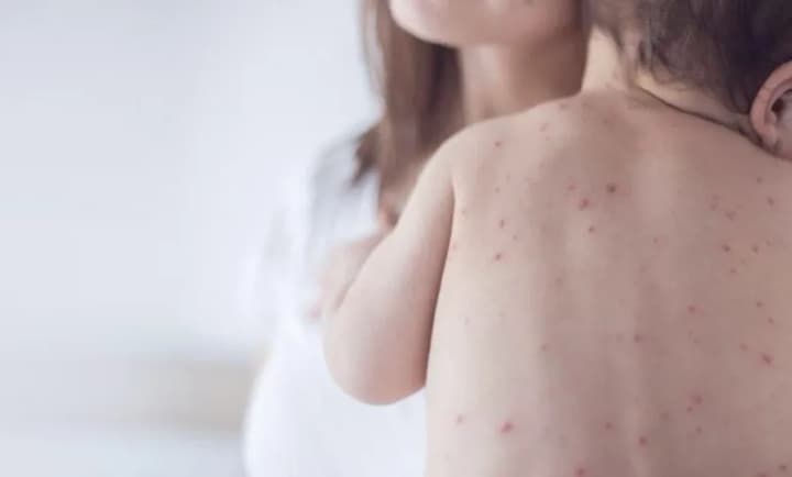 There is a risk of a repeat of the measles epidemic in Ukraine