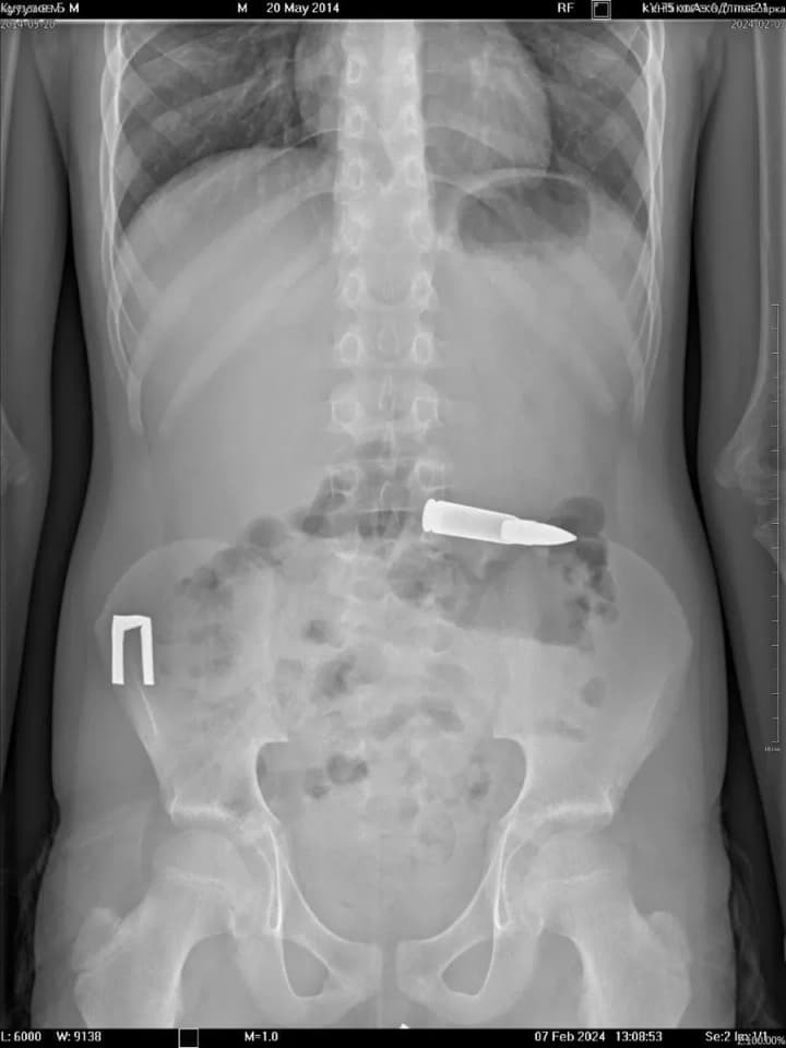 Child swallowed a bullet in Kyiv region