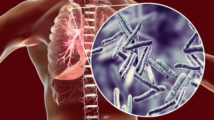 Сьогодні Всесвітній день боротьби із туберкульозом: в Україні зростає захворюваність на туберкульоз серед дітей та підлітків