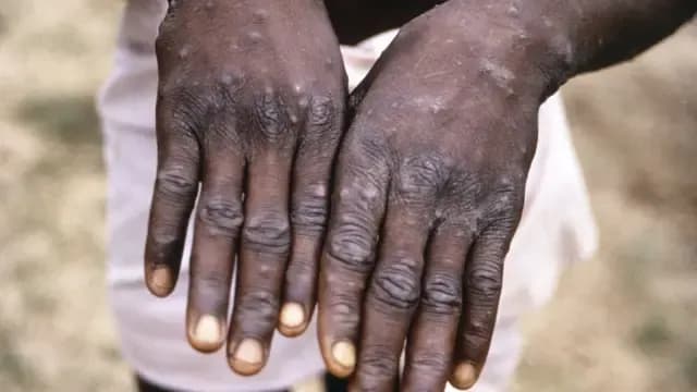 Новий штамп мавпячої віспи “mpox” поширюється в Конго