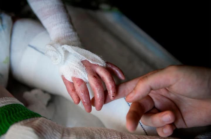 Международная практика лечения "людей-бабочек" обновляется, но в Украине застыла во времени