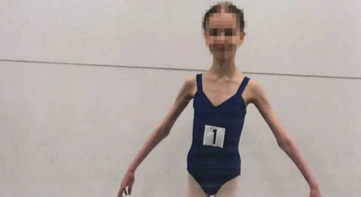 At the age of 17, she weighed 27 kg: a couple whose daughter was sick due to constant malnutrition was convicted in Australia
