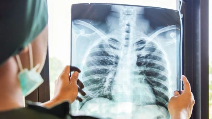 The Public Health Center of the Ministry of Health refuted the myth about tuberculosis