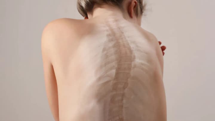 Physical therapist explained the possible consequences of scoliosis and the causes of its occurrence