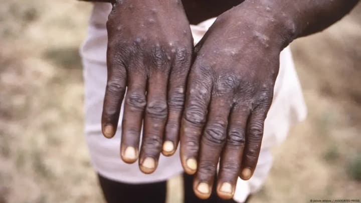 WHO lifts monkeypox emergency but urges vigilance