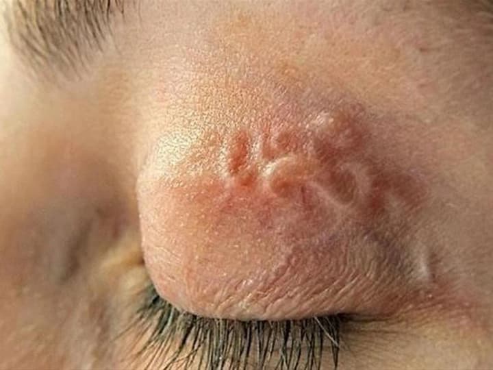 Во Львове врачи извлекли из глаза пациента 12-сантиметрового глиста, который попал в организм после укуса комара