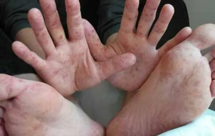 Рука-нога-рот або вірус Коксакі - як ним заражаються люди та чим небезпечна інфекція