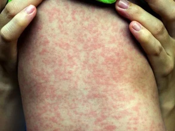 z-pochatku-2018-v-dityachu-infektsiynu-likarnyu-gospitalizovano-16-ditey-kmda