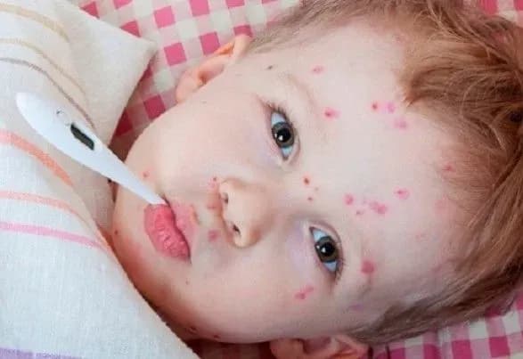 spalakh-zakhvoryuvanosti-na-kir-v-ukrayini-protrimayetsya-sche-priblizno-misyats-ekspert