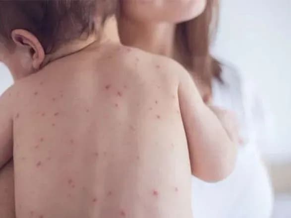 moz-v-odeskiy-oblasti-vid-koru-pomerla-5-misyachna-ditina