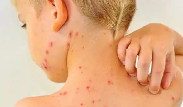 protyagom-tizhnya-na-zakarpatti-zafiksuvali-ponad-150-novikh-vipadkiv-koru