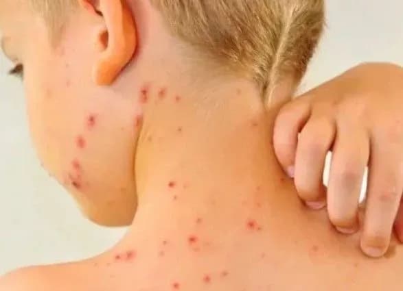 na-kirovogradschini-pidtverdili-mayzhe-180-vipadkiv-koru