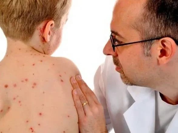 za-rik-zakhvoryuvanist-na-kir-v-ukrayini-zbilshilasya-v-70-raziv-nardep