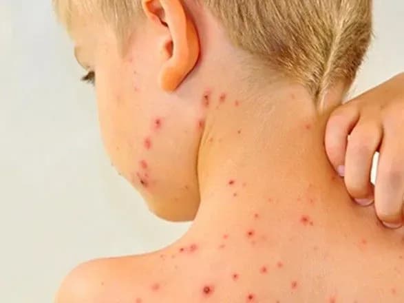 na-kirovogradschini-zareyestruvali-pyat-novikh-vipadkiv-koru