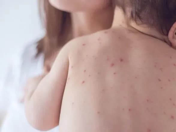 z-pochatku-roku-vid-koru-v-ukrayini-pomerli-15-osib