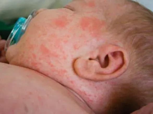 u-lvovi-schodnya-gospitalizuyut-25-30-osib-khvorikh-na-kir