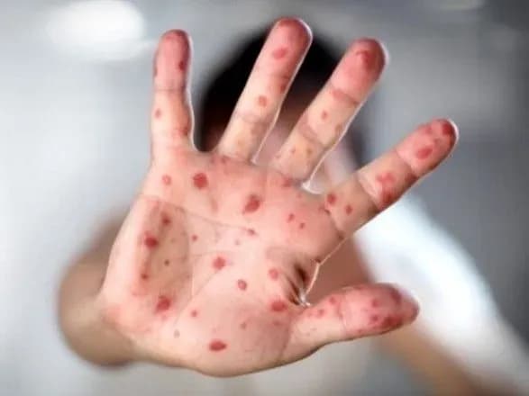 moz-do-kintsya-tizhnya-virishit-chi-ye-v-ukrayini-epidemiya-koru