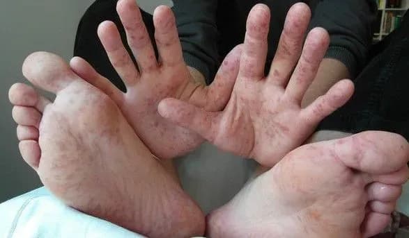 za-kilkistyu-khvorikh-v-ukrayini-vzhe-davno-yde-epidemiya-koru