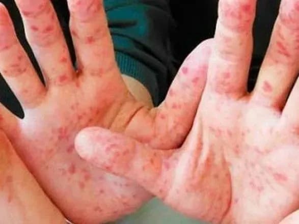 blizko-desyatka-viyskovikh-v-den-zakhvoryuyut-na-kir