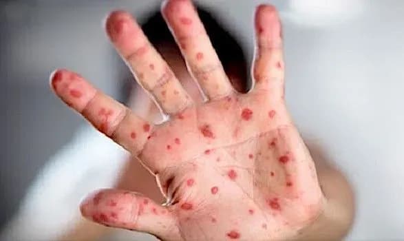 u-gruziyi-prodovzhuye-zrostati-zakhvoryuvanist-na-kir