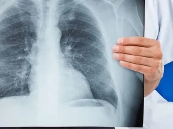 kiyanam-zaproponuvali-zrobiti-bezkoshtovnu-flyuorografiyu