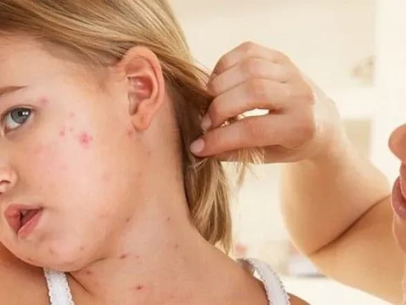 u-kramatorsku-gospitalizuvali-chotirokh-ditey-ta-20-doroslikh-cherez-kir