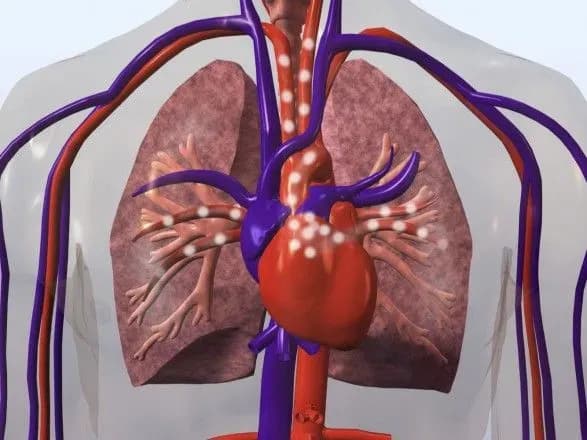 nabryaki-vrantsi-mozhut-svidchiti-pro-rak-legeniv-doslidzhennya