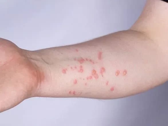 v-ukrayini-pidtverdili-drugiy-vipadok-vispi-mavp