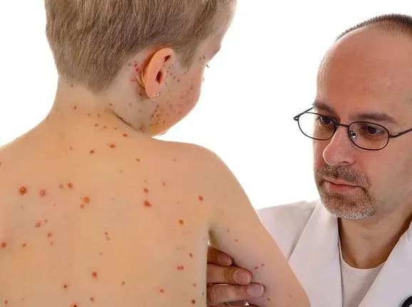 v-moz-poyasnili-scho-robiti-nevaktsinovaniy-lyudini-u-razi-kontaktu-z-khvorim-na-kir