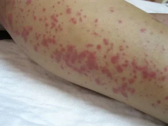 leptospiroz-na-chernigivschini-infektsiyna-khvoroba-viyavlena-u-12-lyudey-sered-nikh-dvoye-ditey