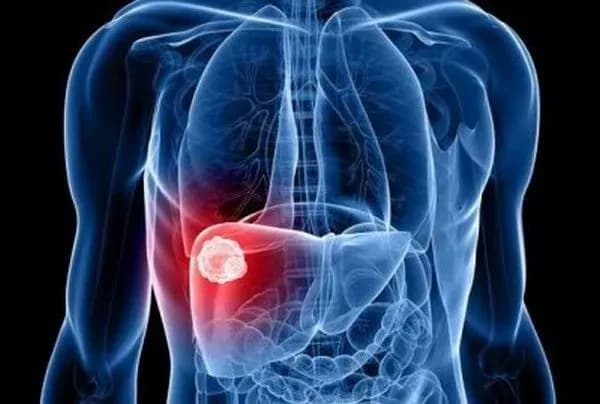 hepatitis-a-in-vinnytsia-region-experts-talk-about-the-possibility-of-a-new-wave-of-morbidity